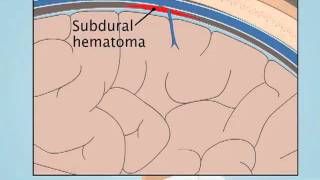 Understanding Subdural Hematoma [upl. by Lever]