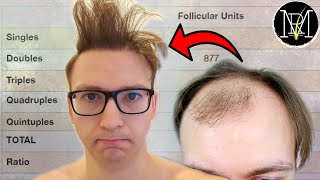 How do I style my Hair Transplant [upl. by Demmahom825]