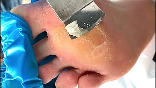 Callus removal from feetampFoot scraping dead skin【Xiao Yan pedicure】stress 813 [upl. by Herzig307]