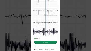 Síndrome de Marfan com aneurisma de aorta ascendente e insuficiência aórtica cardiologia [upl. by Lokcin]