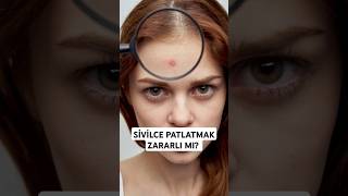 Sivilce patlatmak zararlı mı shorts sivilce acne akne [upl. by Hamid]