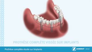 Implant dentaire  implantdentca  Prothèse complète vissée sur implants [upl. by Neehs]