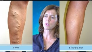 Amazing Results from Varicose Vein Surgery [upl. by Iak]