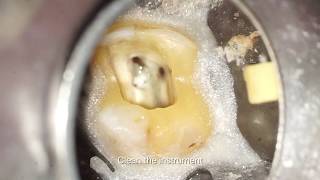 VDW Dental · RPILOT  Clinical use in calcified channel clinical video [upl. by Anisamot]