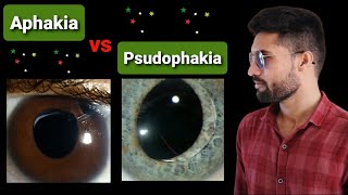 Aphakia  Psudophakia lecture opthalmology [upl. by Dulcy]