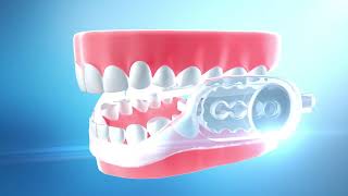 SleepRight UltraComfort Dental Guard at Walmart [upl. by Diraf]