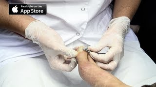 Ingrown Toenail Removal Surgery [upl. by Brahear]