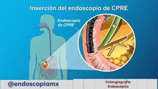 Endoscopia de Vías Biliares o Colangiografía Endoscópica CPRE [upl. by Ycrep517]