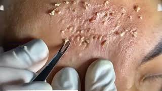 Acne amp Blackhead Treatment Blackhead Removal on forehead  Remove Blackhead removeblackhead [upl. by Sucramad]