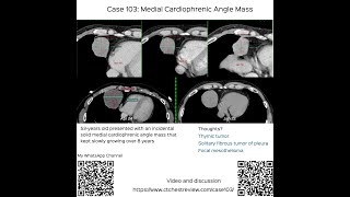 Case 103 Solid Medial Cardiophrenic Angle Mass and SFTP [upl. by Eihpos]