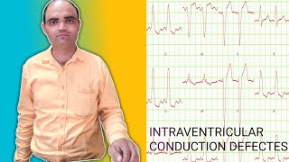 INTRAVENTRICULAR CONDUCTION DEFECTES [upl. by Eelac200]