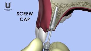 ULTRATOOTH IMPLANT THE FIRST EXPANDABLE IMMEDIATE LOAD IMPLANT [upl. by Etneciv]