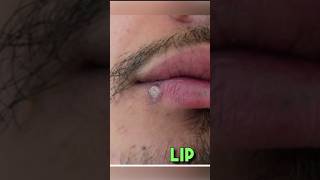 Behind these common skin lesions clinical Skin [upl. by Anomar]