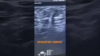 EPIGASTRIC HERNIA usg usgs EPIGASTRIC HERNIA [upl. by Shiff]