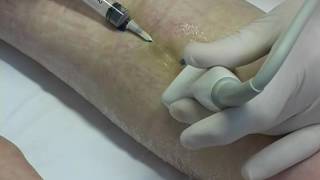 Foam sclerotherapy  aspiration of thrombus [upl. by Liddy]