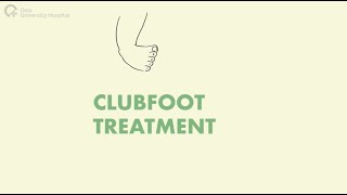 Clubfoot Treatment [upl. by Willmert]