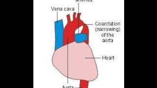 Coarctation of the Aorta [upl. by Yenettirb]