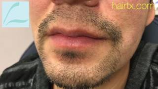 Dallas BeardGoateeMoustache Hair Transplant HD CloseUp Result [upl. by Kcirdef]