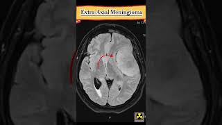 ExtraAxial Meningioma  mri medicalimaging [upl. by Donia]