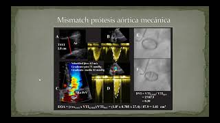 Prótesis valvulares segunda parte [upl. by Fokos]