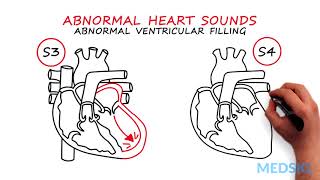 Abnormal Heartsounds and Murmurs Which heart sounds should worry you [upl. by Malinde]