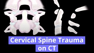 Cervical Spine Trauma on CT [upl. by Dane]