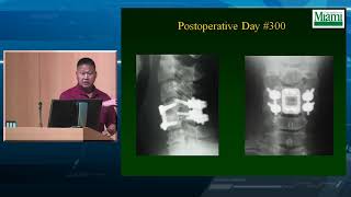 Cervical Facet Fractures and Dislocations [upl. by Adelaida]