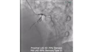 ENDOSTENT amp SLEEK NC Angioplasty Case video1 [upl. by Meid]