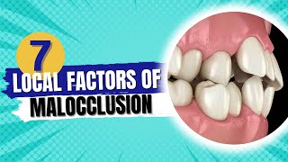 Etiology of malocclusion quotLocal factors of malocclusionquot  Orthodontics [upl. by Ahtamat]