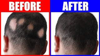 Reversing Alopecia The Power Of 3 Trace Minerals [upl. by Steffin]