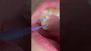 SDF doesnt stain sound tooth structure [upl. by Zippora]