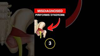 Misdiagnosed Piriformis Syndrome Fixed in Seconds [upl. by Korb611]