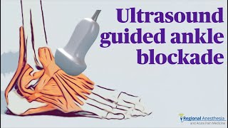 Ultrasound Guided Ankle Block [upl. by Katuscha581]