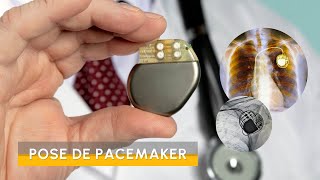 Pose de pacemaker stimulateur cardiaque en Turquie [upl. by Nanine]