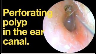 Perforating polyp in the ear canalear wax removal  ear cleaning  ASMR  relaxation  relax [upl. by Namyw816]