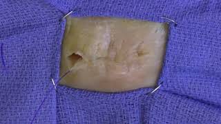 Intradermal Suture Pattern [upl. by Naiva]