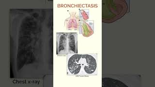 Bronchiectasis  Quick Facts [upl. by Ahsilef513]