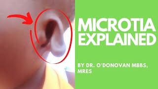 Explaining Microtia an abnormally shaped ear with Dr ODonovan [upl. by Newton162]