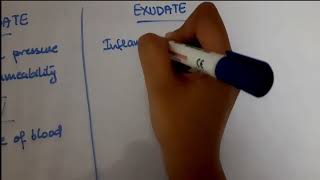 Pleural Effusion  EXUDATE vs TRANSUDATE  Lights criteria [upl. by Ollopa]