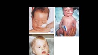 case 347 zellweger syndrome cerbrohepatorenal syndrome hypotonia seizure jaundice dysmorphic [upl. by Catlaina]