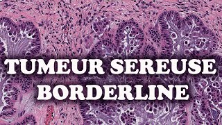 LA TUMEUR SEREUSE BORDERLINE DE L’OVAIRE Partie 3  PATHOLOGIE [upl. by Ahserkal]