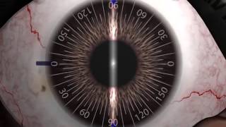 Auroflex Toric Marking amp Implantation guide [upl. by Wunder933]