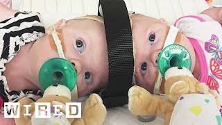 Surgeons Break Down Separating Conjoined Twins  WIRED [upl. by Helfand]