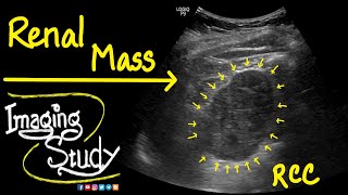 Renal Cell Carcinoma  RCC  Ultrasound  Doppler  Case 41 [upl. by Kinson]