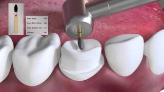 Crown preparation tutorial by Prof Brian Millar [upl. by Wiese838]