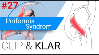 Piriformis Syndrom erklärt  Überlastung der Hüftaussenrotatoren [upl. by Feldt507]