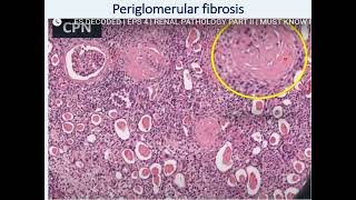 Chronic Pyelonephritis [upl. by Wycoff526]