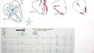 12 Lead EKG Part 5 QRS Axis [upl. by Leynwad]