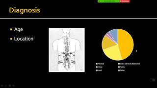 Imaging of Neuroblastoma [upl. by Nednyl]