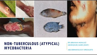 NON TUBERCULUS MYCOBACTERIA SKIN INFECTIONS BY DR ABRAHAM dermatology skincondition funny [upl. by Nosredneh]